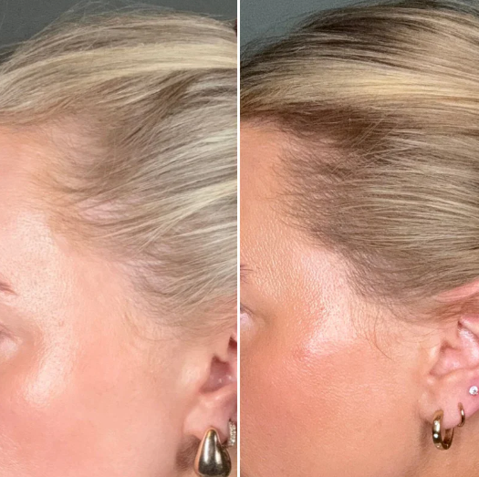 🔥 At-Home Precision Microneedling for Smoother Skin & Healthier-Looking Scalp