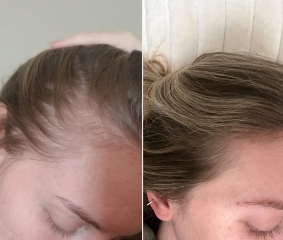 🔥 At-Home Precision Microneedling for Smoother Skin & Healthier-Looking Scalp
