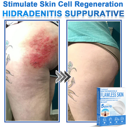 ✅ Celsiora® 2-in-1 Microneedle & Hydrocolloid Patch | Raised Moles,Acne,  Flat Warts & Skin Tags Remover | Improves Wrinkles, Scars & Blemishes | Invisible Pimple Patches for Face & Body