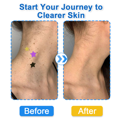 Devareon® 2-in-1 Microneedle & Hydrocolloid Star Patch 🌟 | Acne, Blackheads, Skin Tags & Raised Blemishes Remover 💫 | 6 Colors Pimple Patch for Face & Neck 🌸 | Invisible Star Zit Stickers ✨