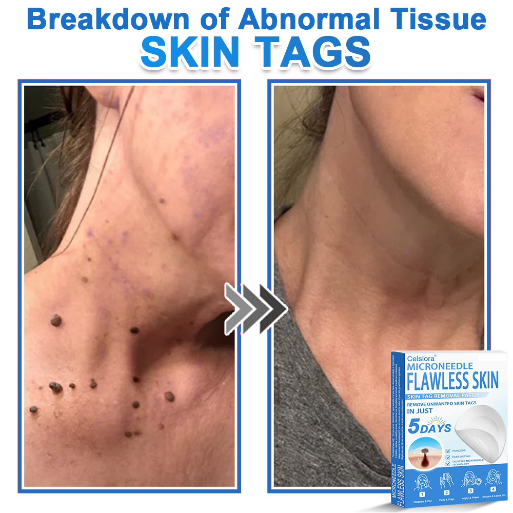 ✅ Celsiora® 2-in-1 Microneedle & Hydrocolloid Patch | Raised Moles,Acne,  Flat Warts & Skin Tags Remover | Improves Wrinkles, Scars & Blemishes | Invisible Pimple Patches for Face & Body