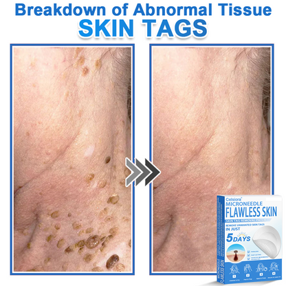 ✅ Celsiora® 2-in-1 Microneedle & Hydrocolloid Patch | Raised Moles,Acne,  Flat Warts & Skin Tags Remover | Improves Wrinkles, Scars & Blemishes | Invisible Pimple Patches for Face & Body