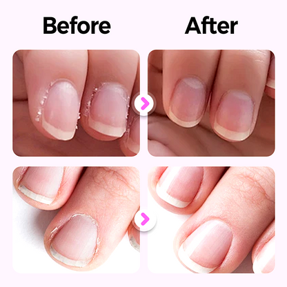 Hjmeta®💜BUY 1 GET 1 FREE💜2026 New Upgraded 3-in-1 Nail Care Pen💅